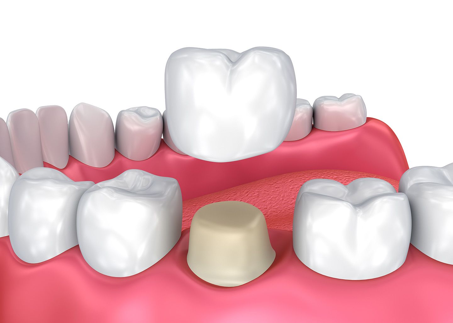 Dental Crowns - Gentle Dentistry