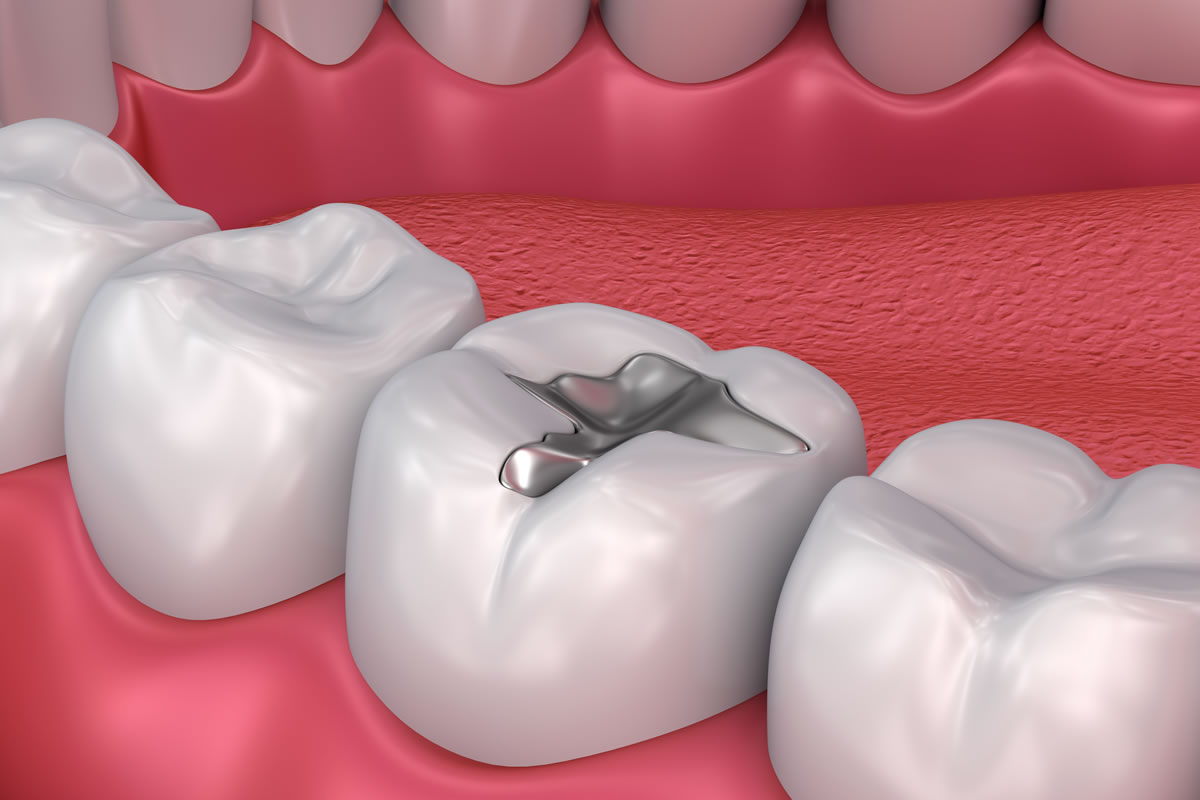 dental-fillings-s