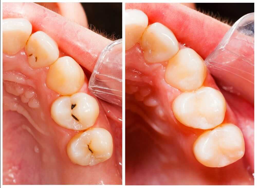 Before and after image of a tooth filling