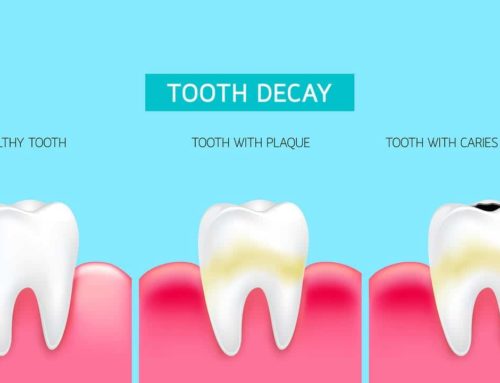 How To Know When You Have Tooth Decay?
