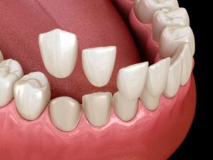 An illustration of dental veneers 